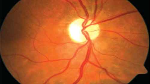 Foto de O que é neuropatia óptica hereditária?