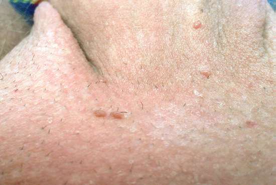 Foto de Condiloma Acuminado: Verruga Genital – Fotos