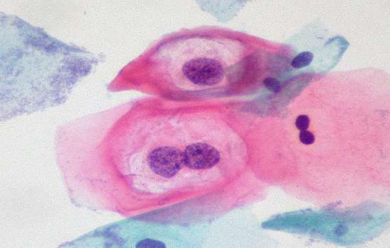 Foto de Papilomavírus humano (HPV): Causas, sintomas, tratamento – Fotos e vídeos